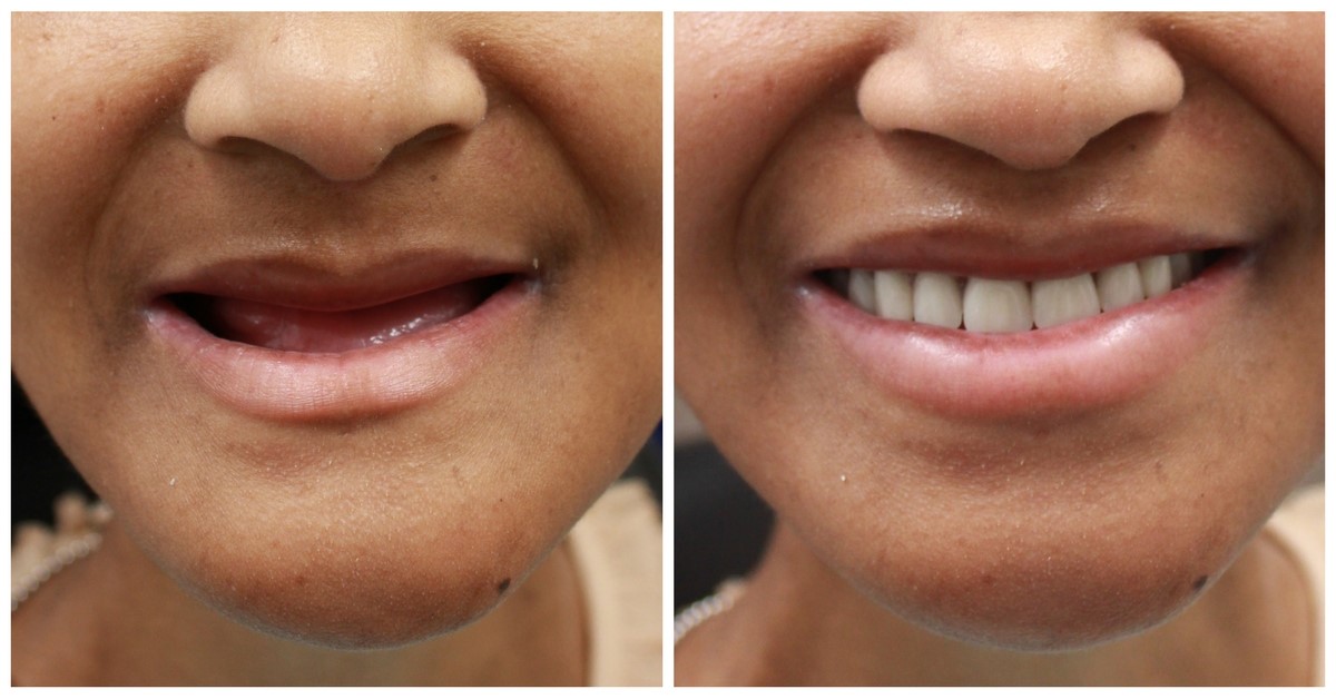 Partial Dentures Before And After Boody IL 62514